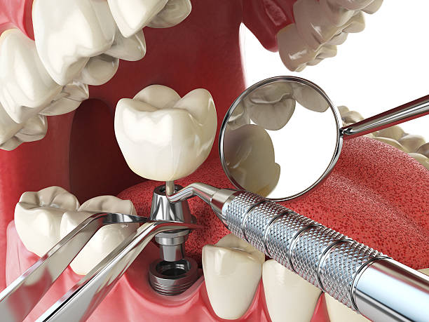 Best Emergency Dentist for Knocked-Out Tooth in Lake Mack Forest Hills, FL